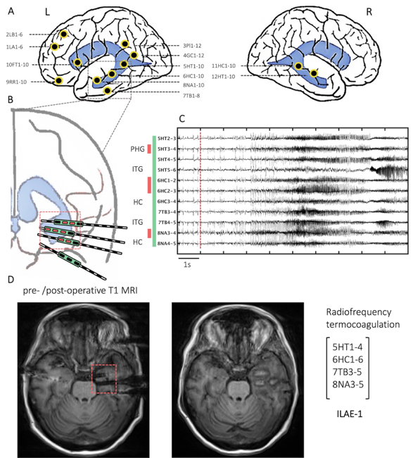 Новая статья Центра языка и мозга в журнале Frontiers in Human Neuroscience